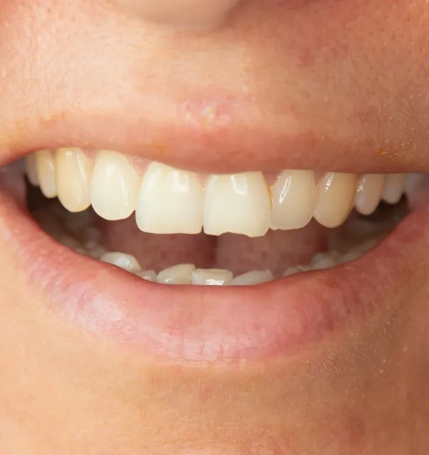 Cracked Teeth Treatment at Copper Hills Dental