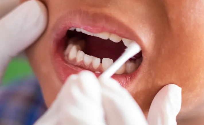 Fluoride Treatment at Copper Hills Dental
