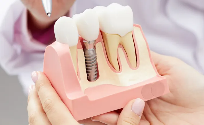 Single-Tooth Dental Implants at Copper Hills Dental