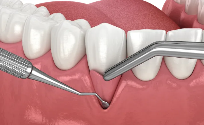 Soft Tissue Grafting at Copper Hills Dental