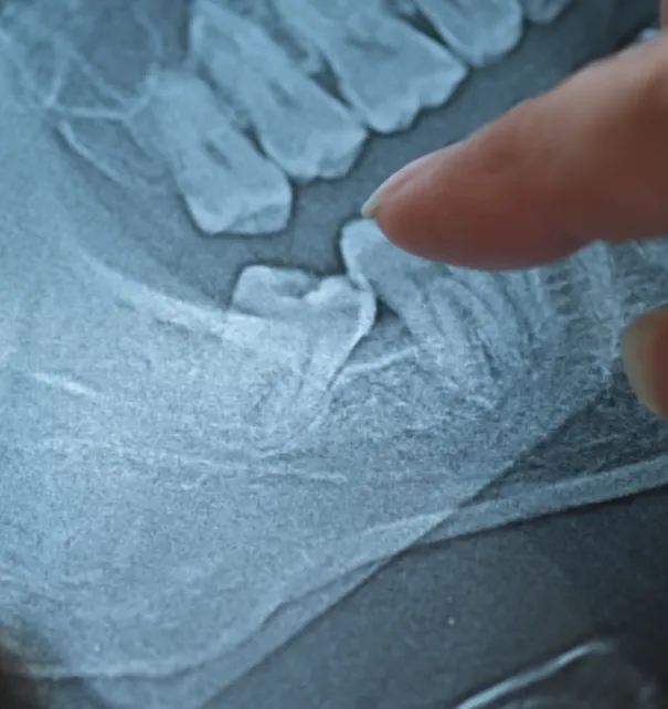 Wisdom Teeth Removal at Copper Hills Dental